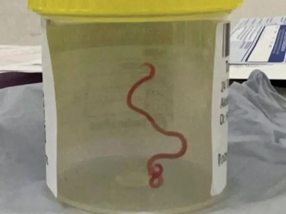 په استرالیا کې ډاکټرانو د یوې مېرمنې له مغزو ۸ سانتي متره ژوندی چینجی لرې کړ