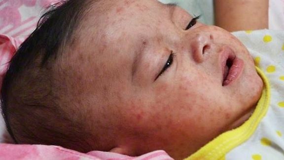 اوچا: په افغانستان کې روانه اونۍ د شري ناروغۍ له ۱۶۰۰ زیاتې مشکوکې پېښې ثبتې شوې دي