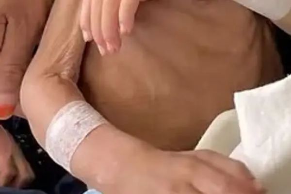 Nearly 3 Million Children in Afghanistan Suffering from Malnutrition, Says WHO