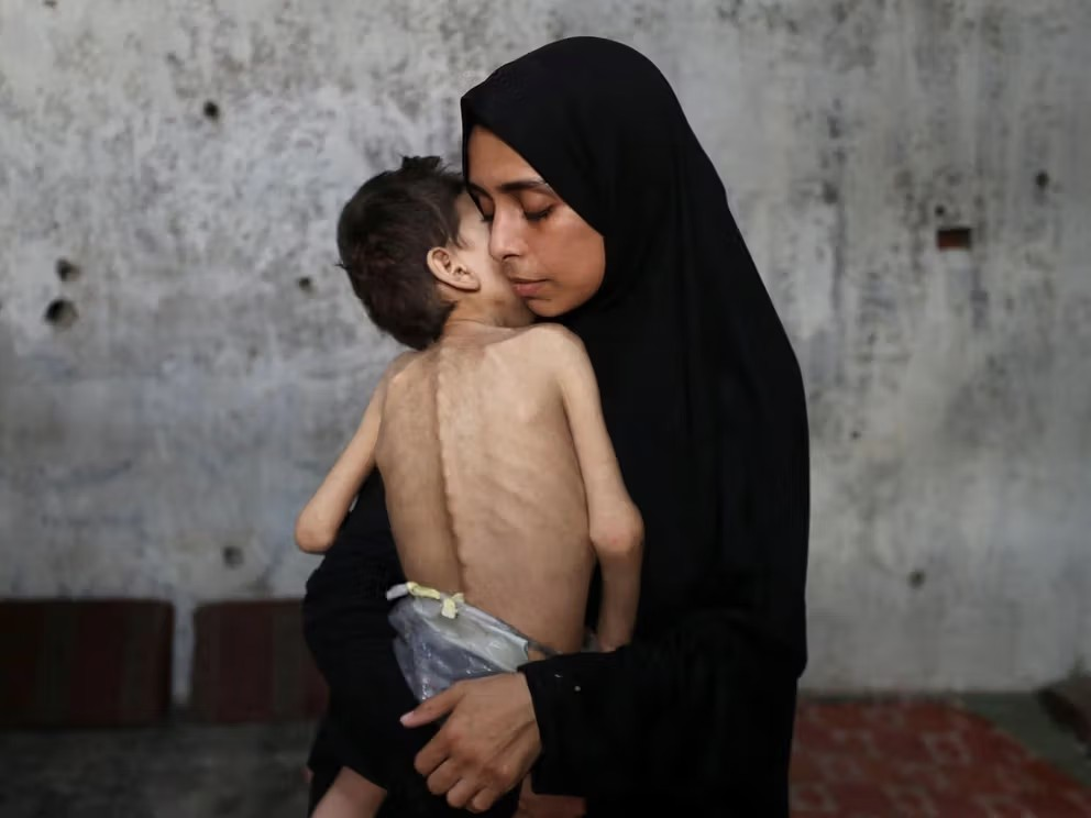 ارتفاع عدد ضحايا المجاعة في غزة إلى 169 بينهم 93 طفلاً