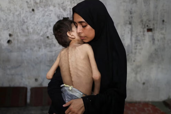 ارتفاع عدد ضحايا المجاعة في غزة إلى 169 بينهم 93 طفلاً