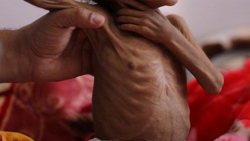 در ۶ ماه گذشته در ولایت غور، ۱۷ کودک از اثر سؤ تغذی جان باختند