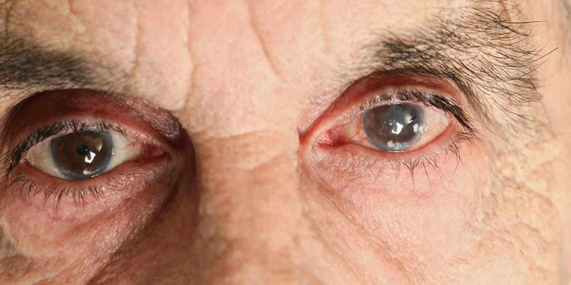 پژوهشگران می‌گویند آلودگی هوا باعث 'پیری زودرس چشم انسان' می‌شود