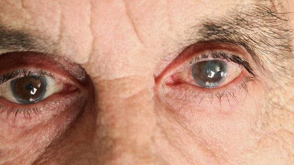 پژوهشگران میگویند آلودگی هوا باعث 'پیری زودرس چشم انسان' میشود