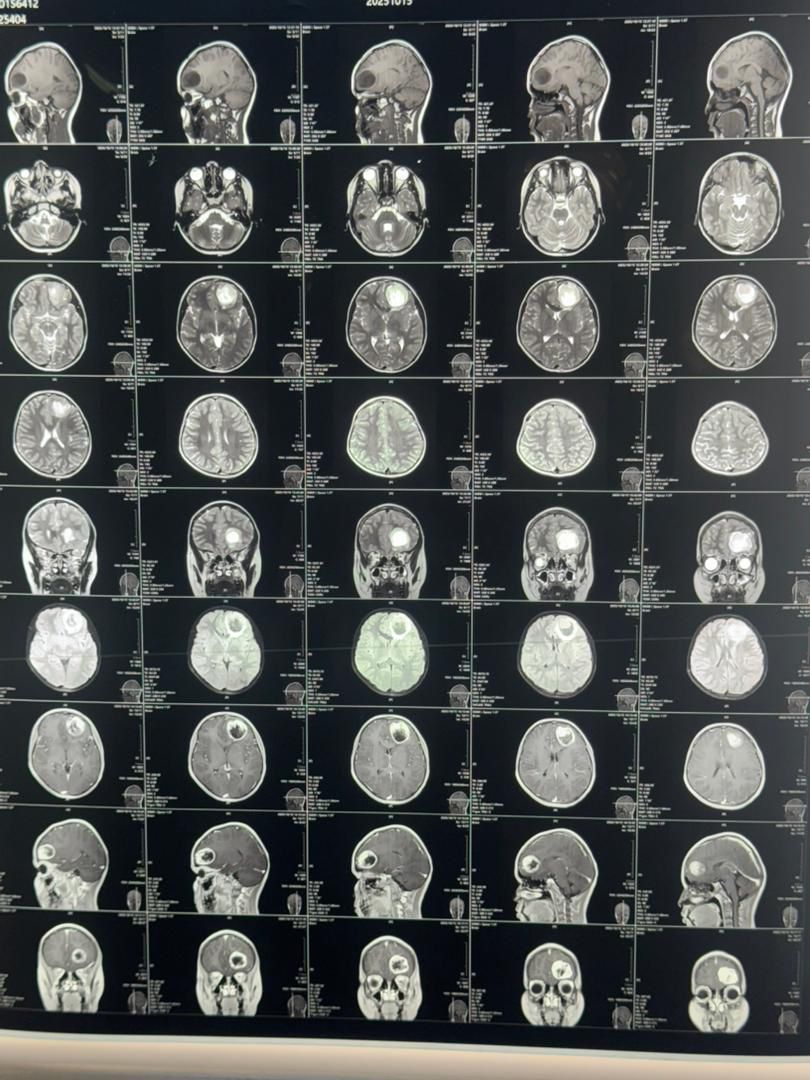 په بلخ کې په لومړي ځل د دماغي تومور جراحي عملیات په بریالیتوب ترسره شول