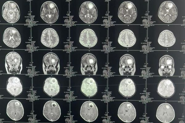 په بلخ کې په لومړي ځل د دماغي تومور جراحي عملیات په بریالیتوب ترسره شول