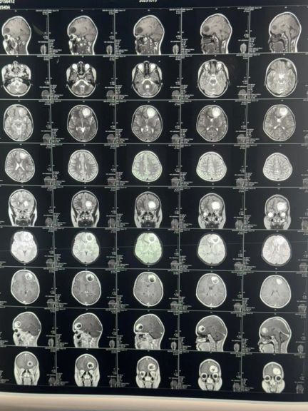 په بلخ کې په لومړي ځل د دماغي تومور جراحي عملیات په بریالیتوب ترسره شول