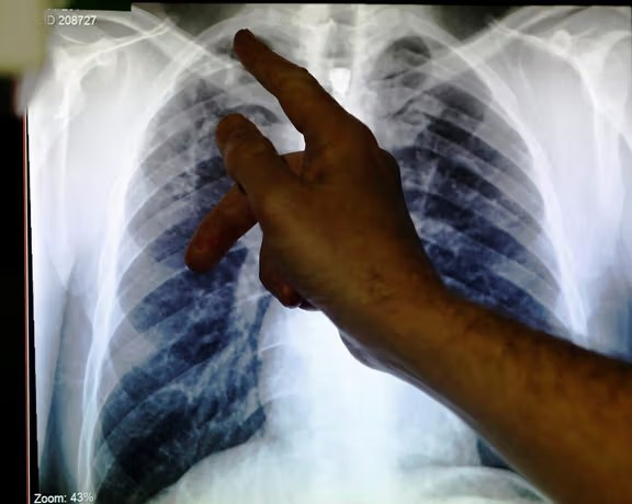 تېرکال له یو مېلیون څخه ډېر کسان د نري رنځ له امله مړه شوي