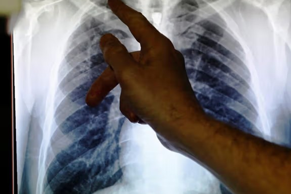 تېرکال له یو مېلیون څخه ډېر کسان د نري رنځ له امله مړه شوي