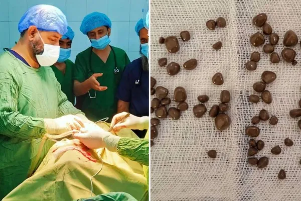 په ننګرهار کې د یوه شل کلن ناروغ له پښتورګي ۸۵ تېږې اېستل شوې دي