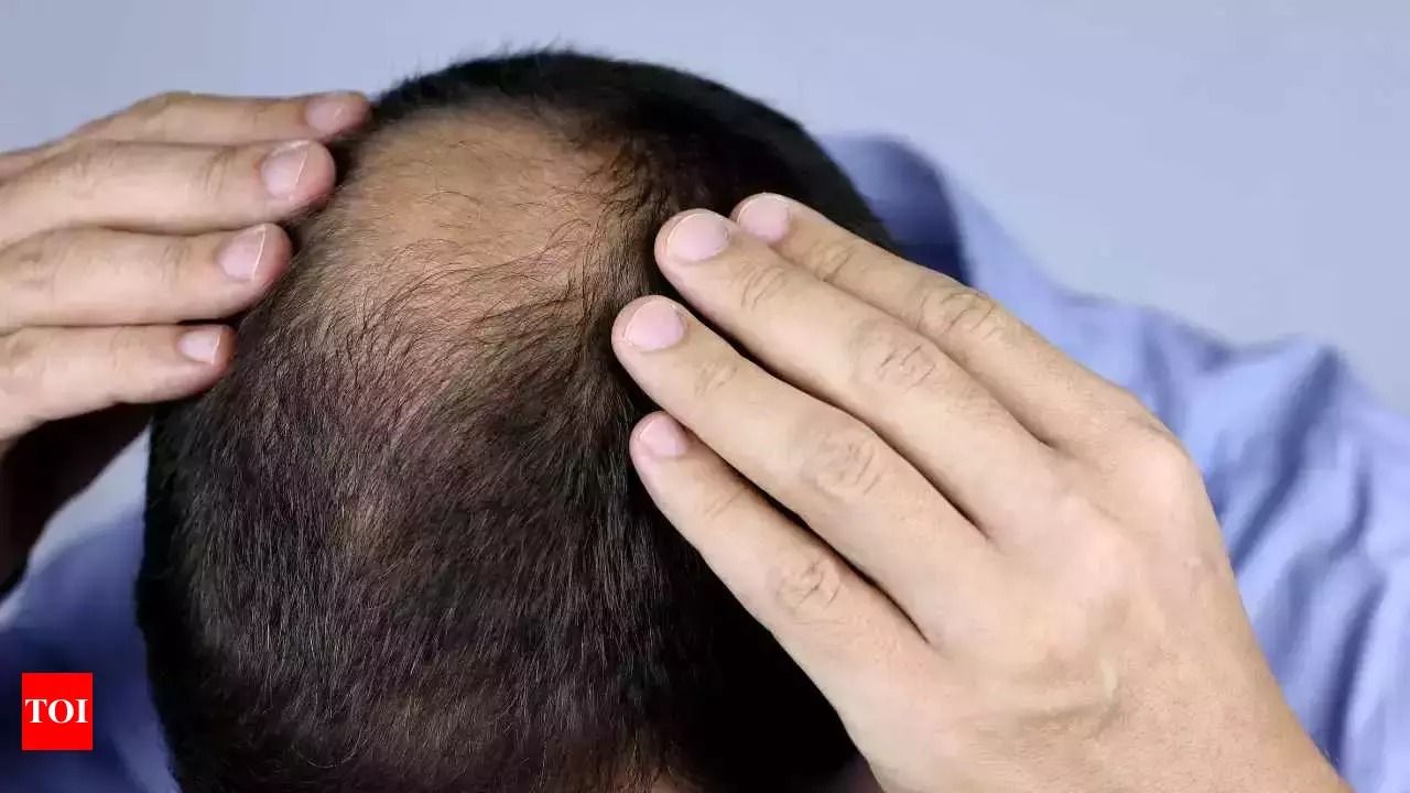 یک ویروس عجیب در چند روستای هند باعث ریزش موی بیش از ۱۵۰ نفر شد