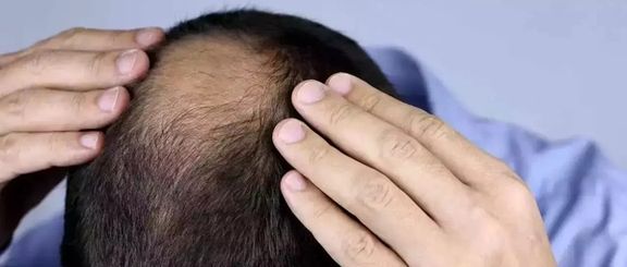 یک ویروس عجیب در چند روستای هند باعث ریزش موی بیش از ۱۵۰ نفر شد