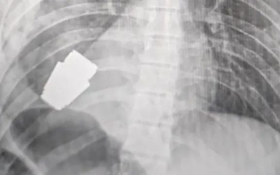 جراحان یک نارنجک منفجر ناشده را از قفسه سینه یک سرباز اوکراینی بیرون کشیدند