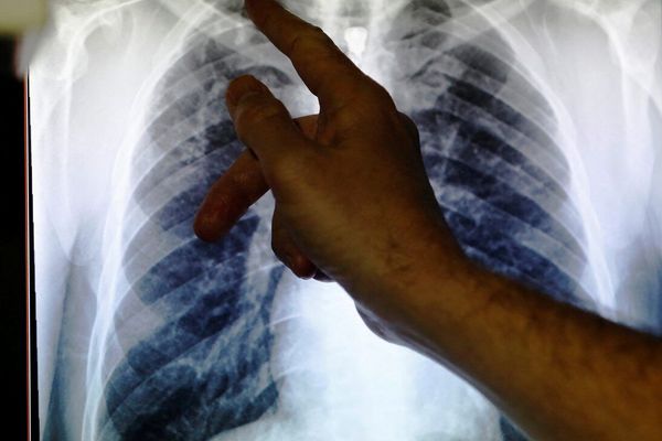 سال گذشته «بیش از یک میلیون نفر» در اثر بیماری سل جان باختند