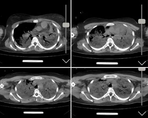 اختصاصی ایراناینترنشنال: سیتیاسکن مهسا نشانگر شکستگی جمجمه، خونریزی و اِدِم مغزی است
