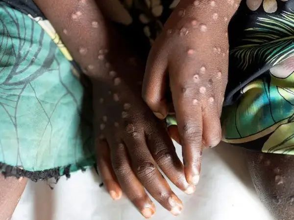 در کمتر از هشت ماه بیش از ۱۸ هزار مورد ام‌پاکس در افریقا شناسایی شده است