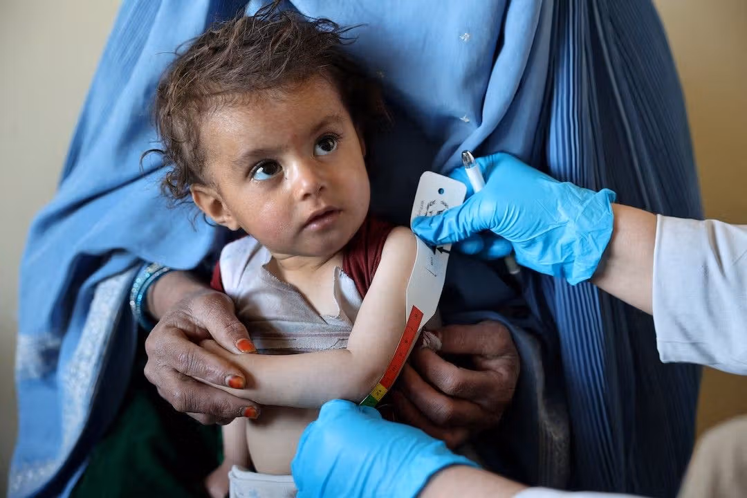 سازمان ملل: حدود ۲۰۰ هزار کودک دیگر افغان با سوءتغذیه حاد مواجه خواهند شد
