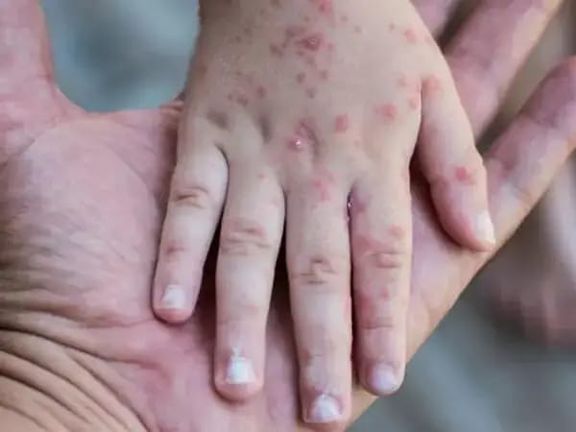 سازمان توسعه بینالمللی امریکا: در سه ماه گذشته، ۱۸۷ هزار کودک در کابل واکسین شدند