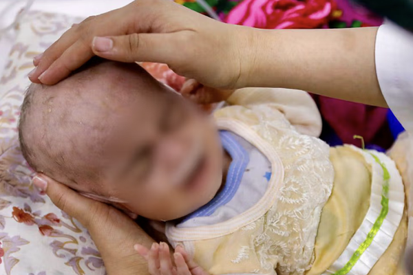 مستشفى ميرويس في قندهار يُضطر بسبب نقص الإمكانات إلى وضع ثلاثة أطفال في سرير واحد