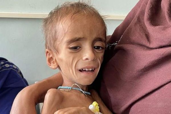 یونېسف: میلیونونه افغان ماشومان له خاموش کړاو او وژونکې لوږې سره مخ دي