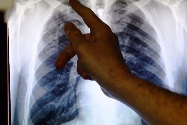 سازمان بهداشت جهانی میگوید توبرکلوز همچنان یک تهدید جدی در افغانستان است