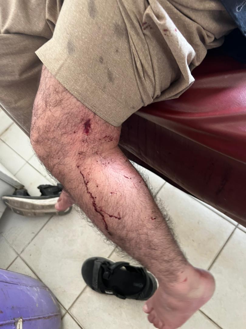 په پېښه کې یو کس په پښه او دوه نور کسان پر لاسونو لګېدلي او برسېرن ټپيان شوي 