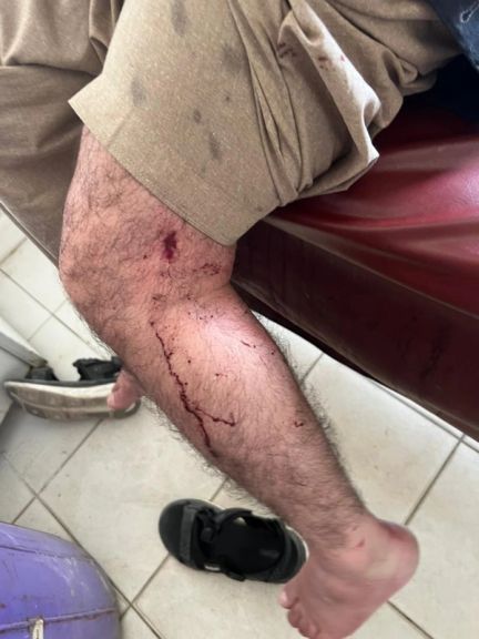 په پېښه کې یو کس په پښه او دوه نور کسان پر لاسونو لګېدلي او برسېرن ټپيان شوي