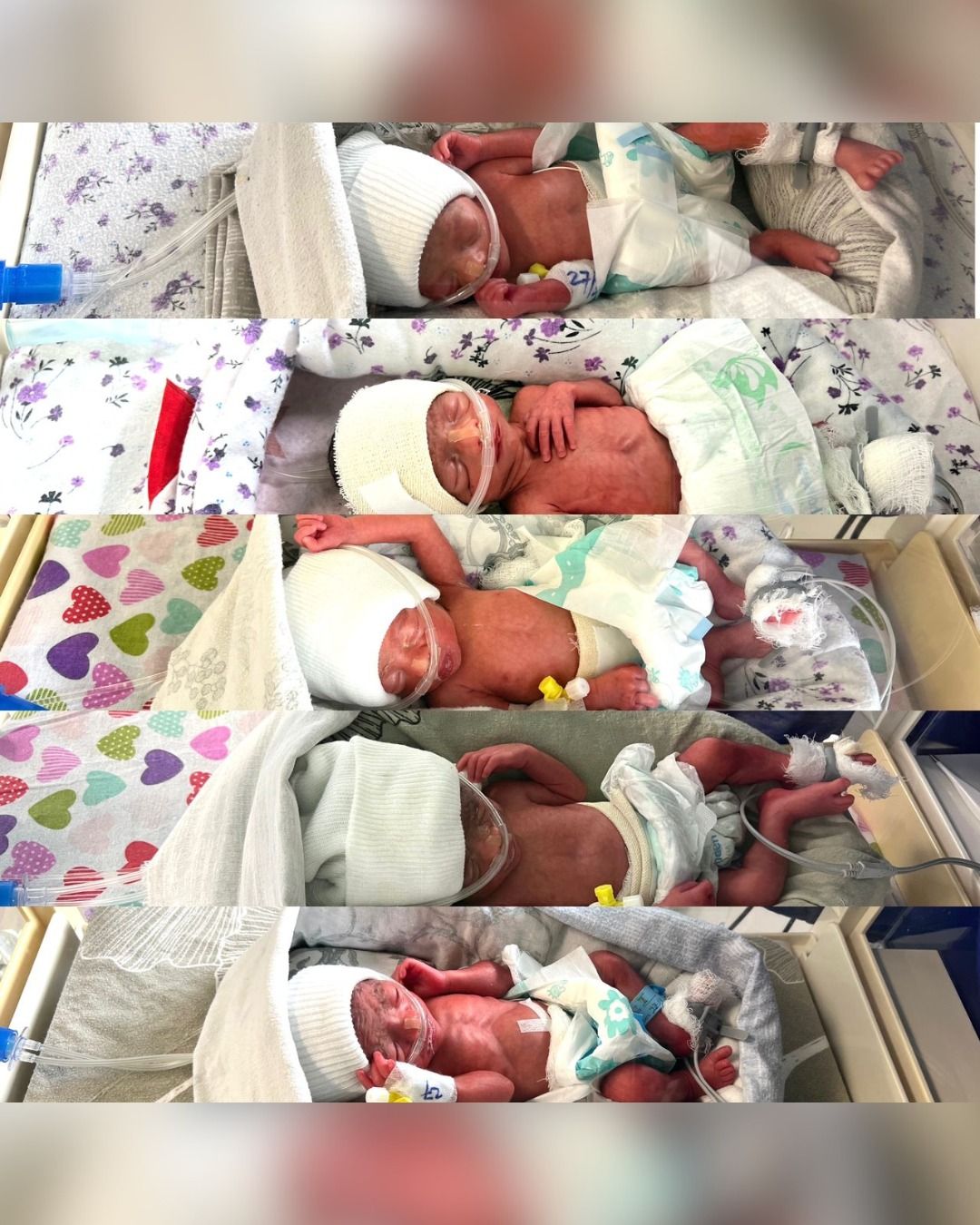 یوې افغانې مور د  کابل په اېمرجنسي روغتون کې  پنځه ماشومان زېږولي 