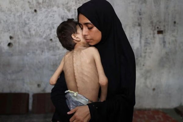 در یک شبانهروز ۳ کودک دیگر به دلیل گرسنگی در غزه جان دادند