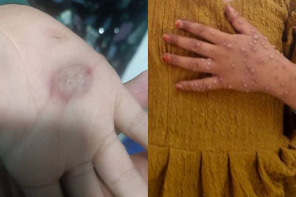 Sources Report 2 Cases of Mpox In Kabul & Paktia Provinces