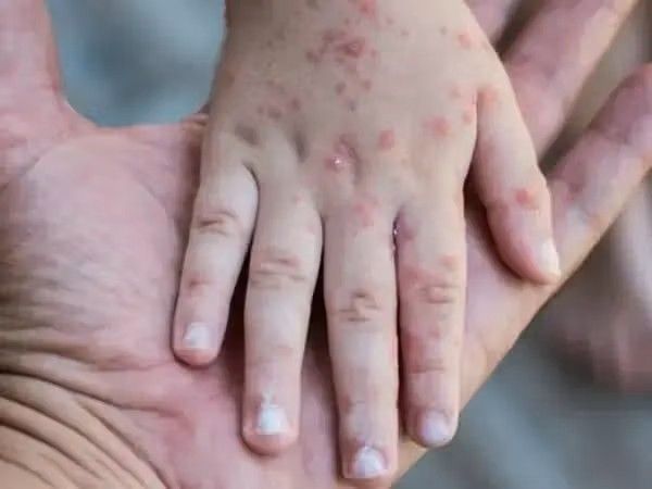 بیش از «۳۰ میلیون کودک» در جهان در برابر سرخکان واکسینه نشده‌اند 