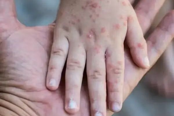 بیش از «۳۰ میلیون کودک» در جهان در برابر سرخکان واکسینه نشدهاند