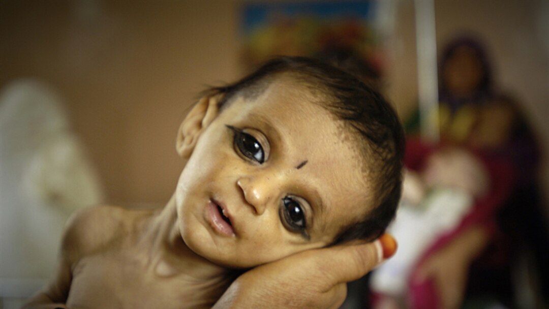 د خوړو نړۍوال پروګرام: هرو لسو ثانیو کې په افغانستان کې یو ماشوم له خوارځواکۍ سره مخ کېږي