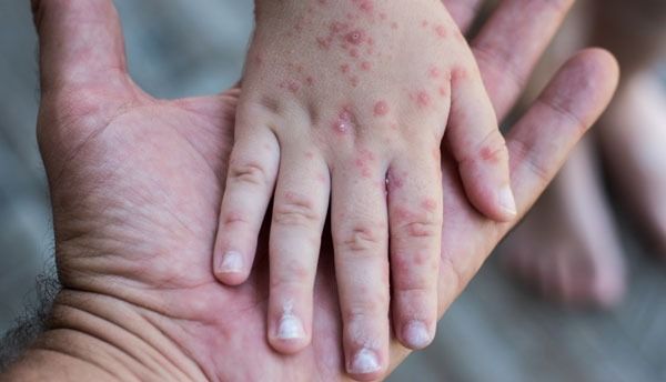 یونیسف: بیش از یک میلیون کودک در افغانستان در برابر بیماری سرخکان واکسن شده‌اند