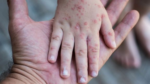 یونیسف: بیش از یک میلیون کودک در افغانستان در برابر بیماری سرخکان واکسن شدهاند