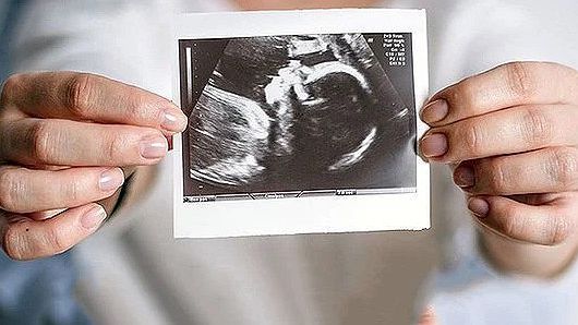 مشاور وزارت صحت ایران: ۴۰ درصد از زنان ایران به دلیل نداشتن توانایی مالی سقط جنین میکنند